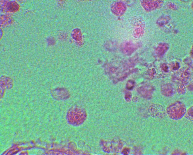 naegleria fowleri : brain-eater amoeba 